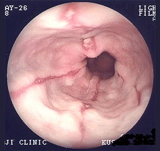 逆流性食道炎の症例